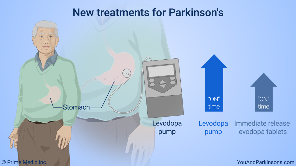 Slide Show Treatment and Management of Parkinson’s Disease
